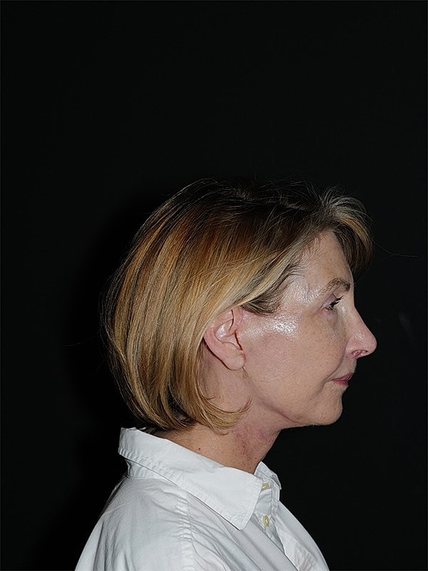 Facelift Neck Lift Before & After