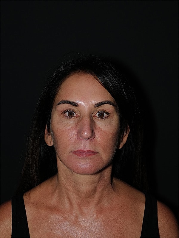 Facelift Neck Lift Before & After