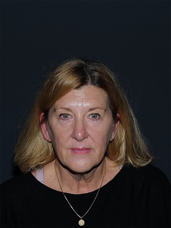 Facelift Neck Lift Before & After