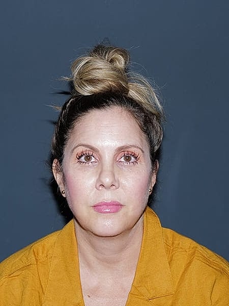 Facelift Neck Lift Before & After