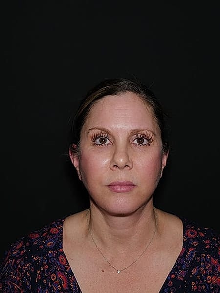 Facelift Neck Lift Before & After