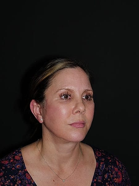 Facelift Neck Lift Before & After