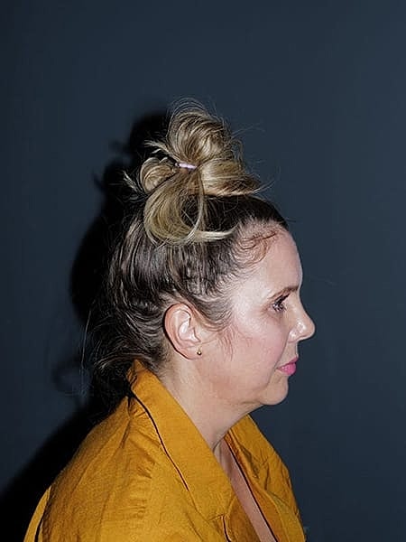 Facelift Neck Lift Before & After