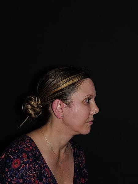 Facelift Neck Lift Before & After
