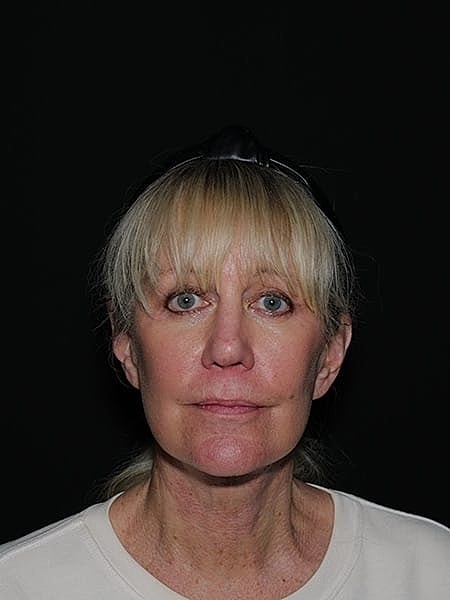 Facelift Neck Lift Before & After