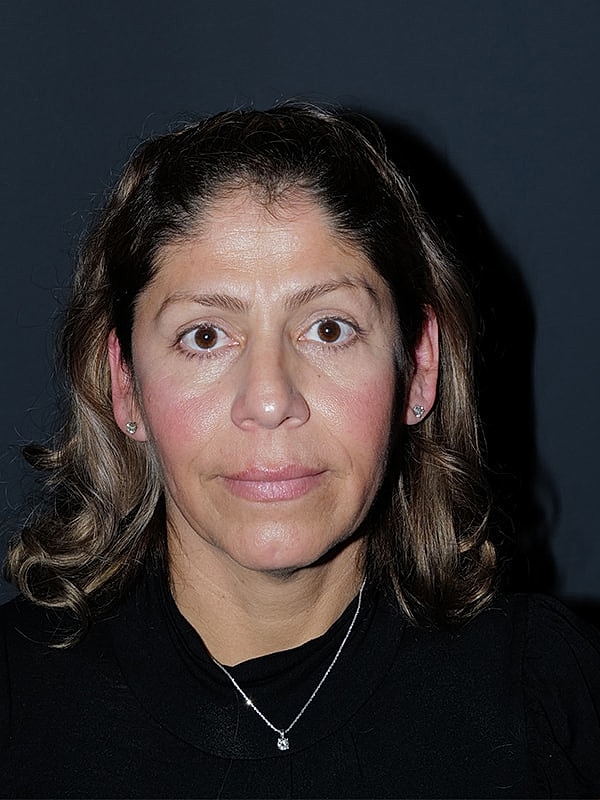Facelift Neck Lift Before & After