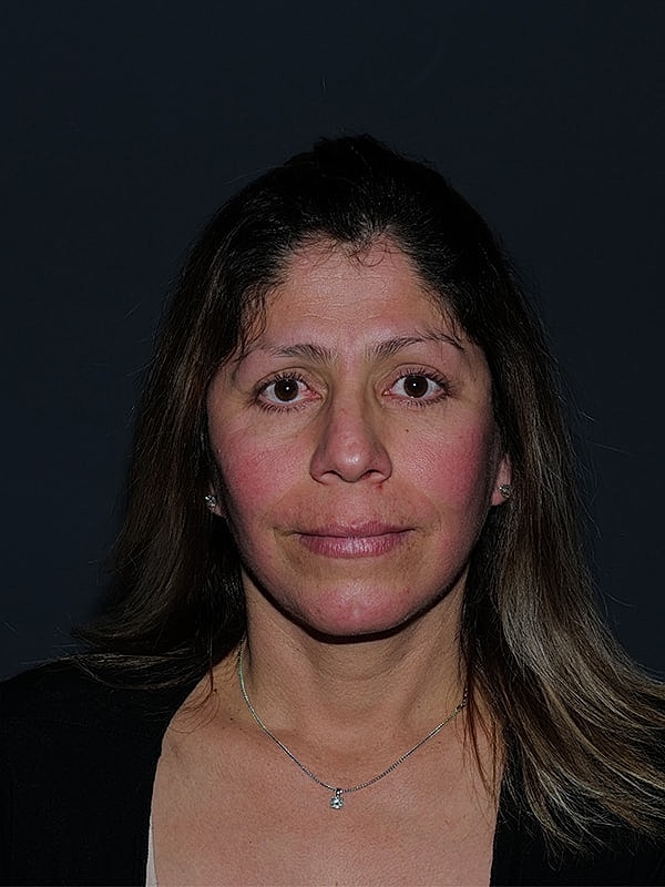 Facelift Neck Lift Before & After