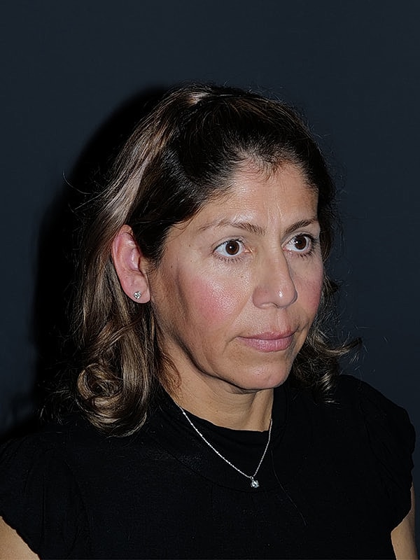 Facelift Neck Lift Before & After