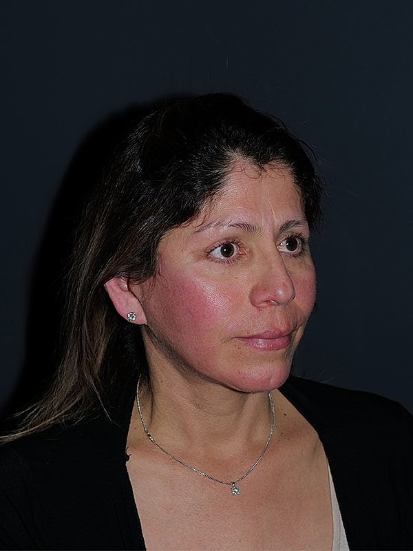 Facelift Neck Lift Before & After