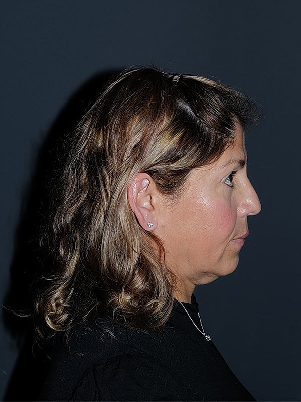 Facelift Neck Lift Before & After