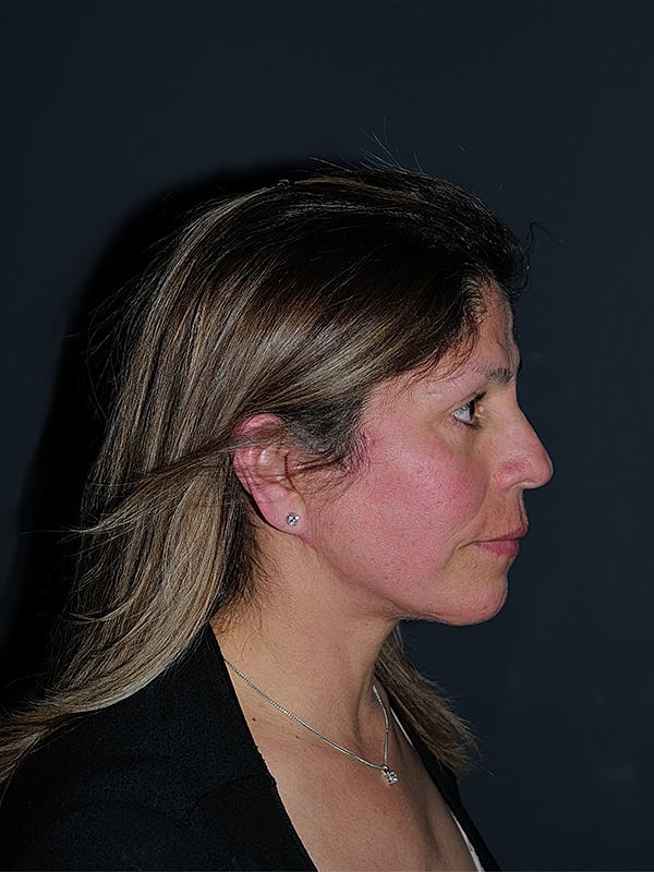 Facelift Neck Lift Before & After