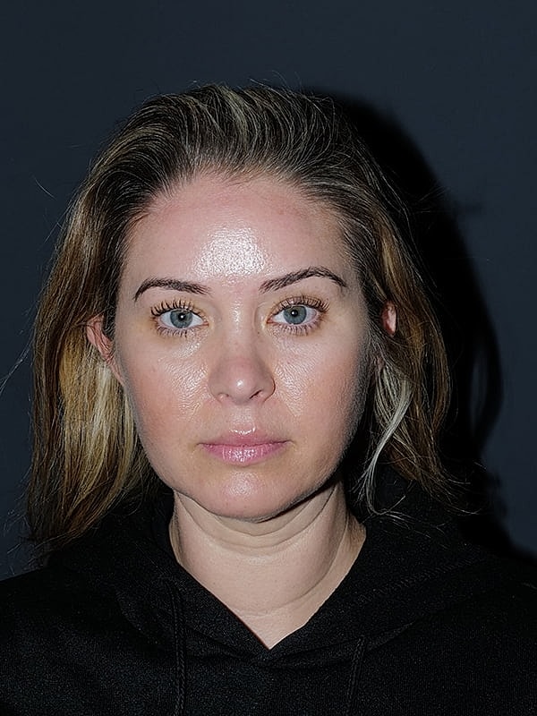 Facelift Neck Lift Before & After