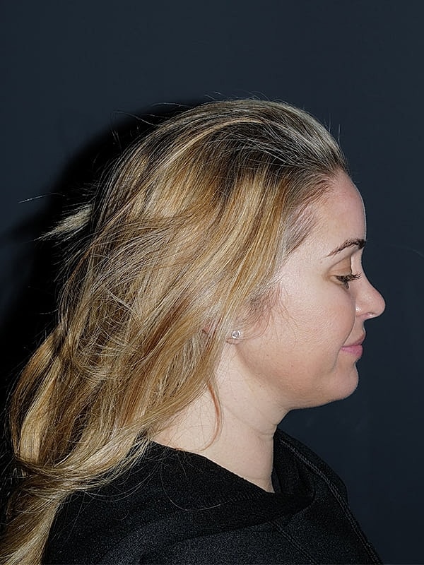 Facelift Neck Lift Before & After