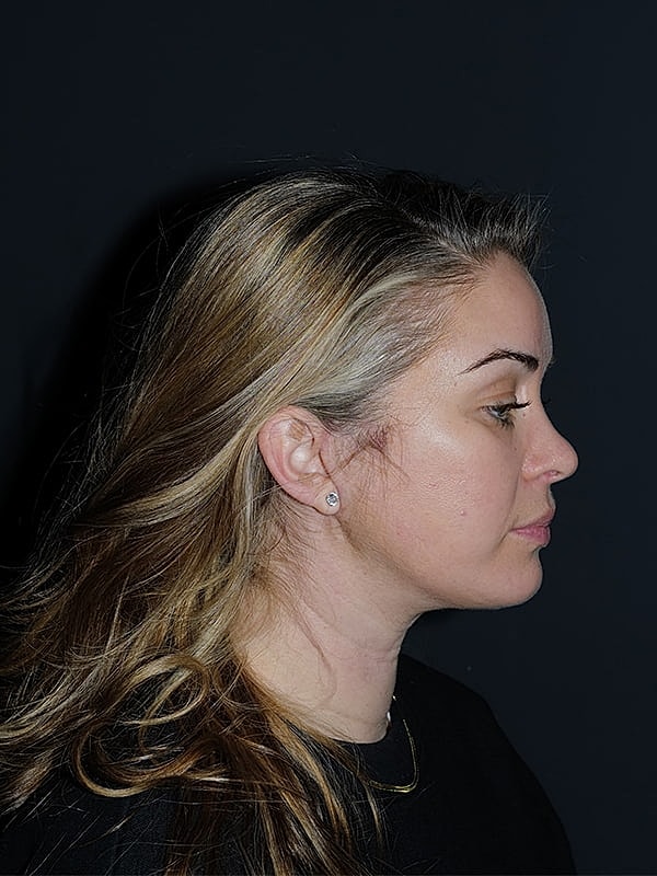Facelift Neck Lift Before & After