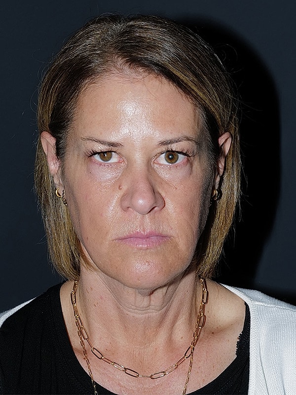 Facelift Neck Lift Before & After