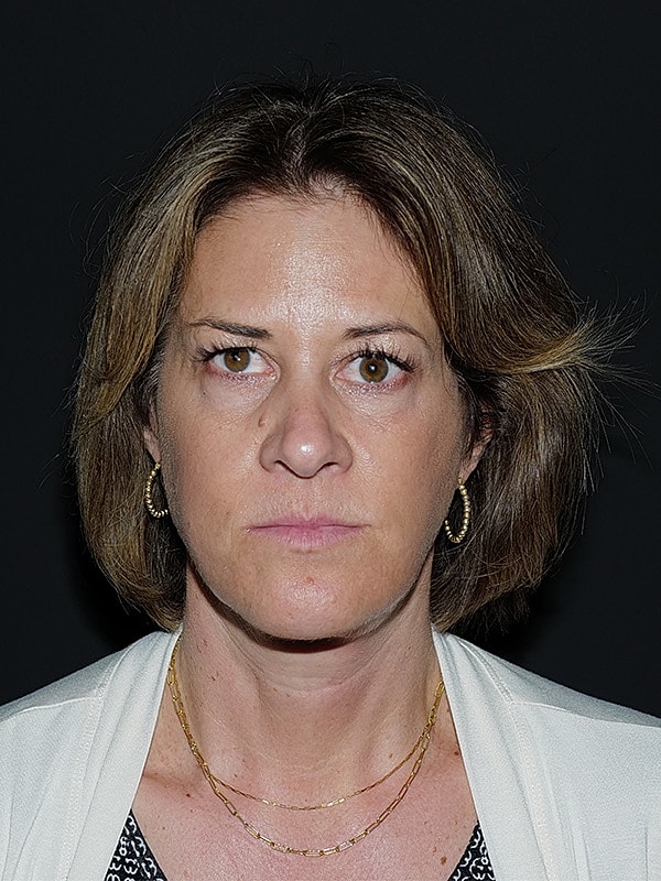Facelift Neck Lift Before & After
