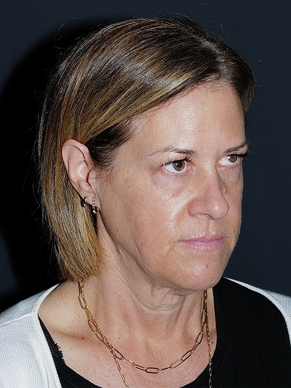 Facelift Neck Lift Before & After