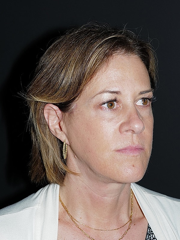 Facelift Neck Lift Before & After
