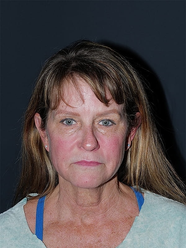 Facelift Neck Lift Before & After
