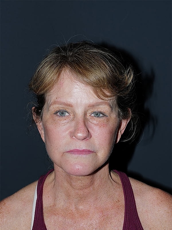 Facelift Neck Lift Before & After