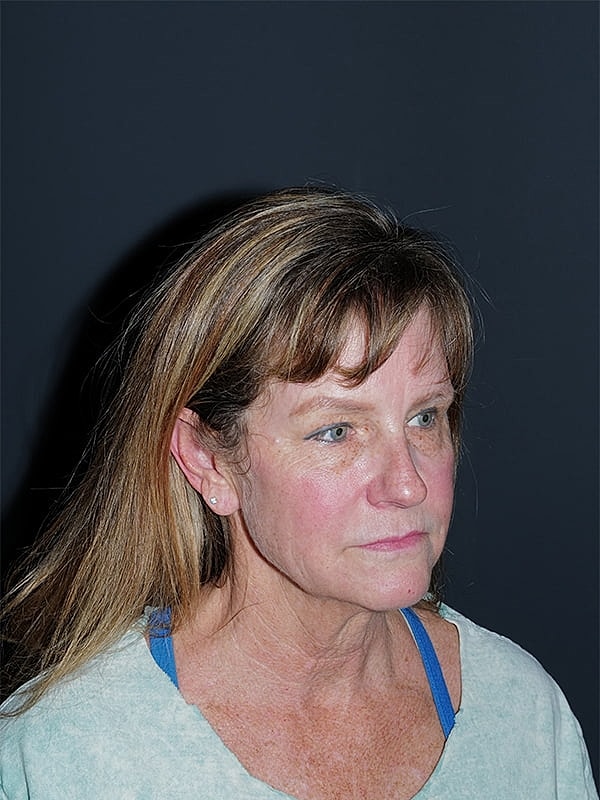 Facelift Neck Lift Before & After