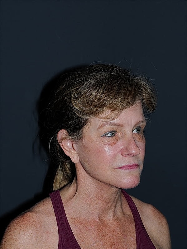 Facelift Neck Lift Before & After