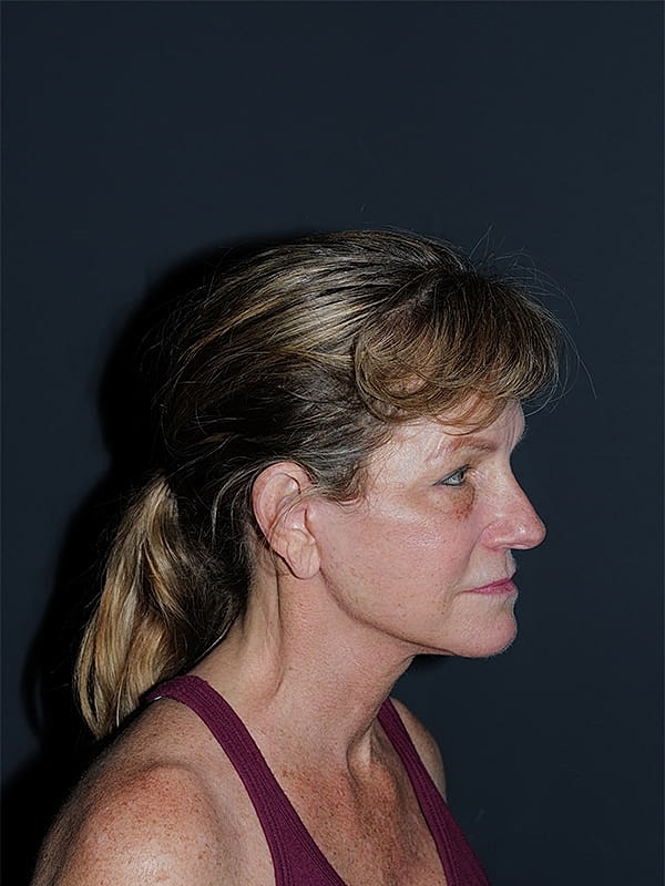 Facelift Neck Lift Before & After