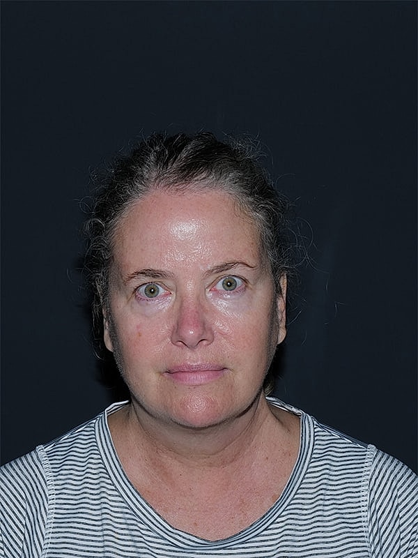 Facelift Neck Lift Before & After
