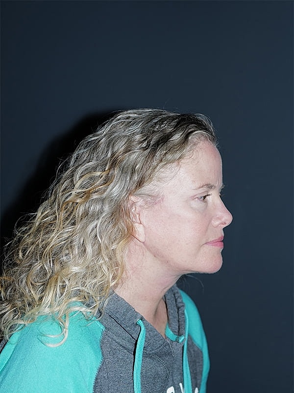 Facelift Neck Lift Before & After