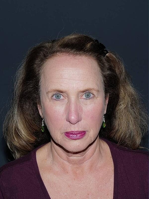 Facelift Neck Lift Before & After