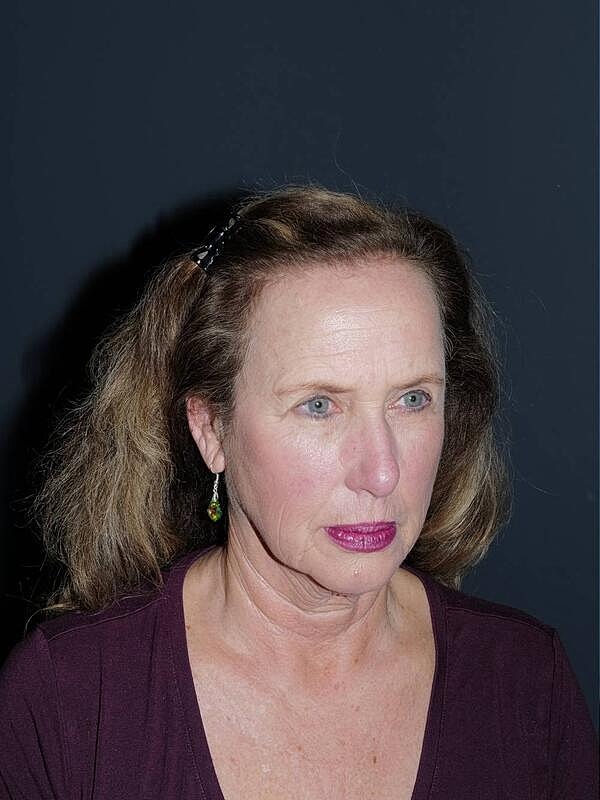Facelift Neck Lift Before & After