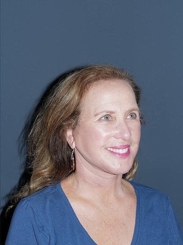 Facelift Neck Lift Before & After