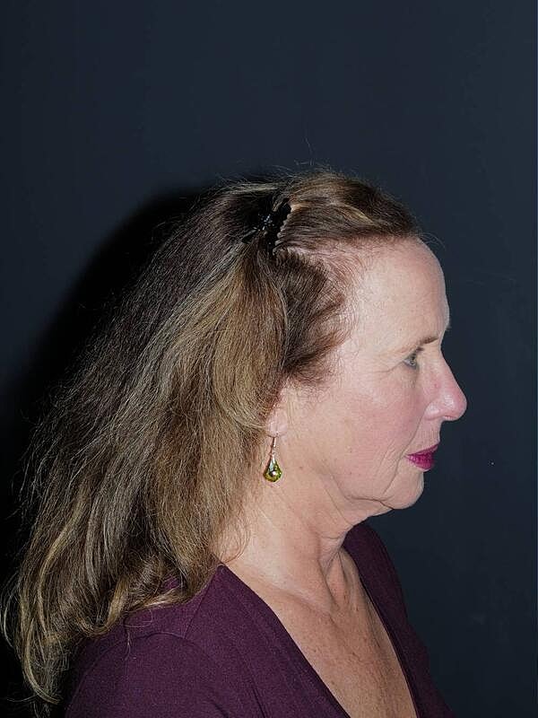 Facelift Neck Lift Before & After