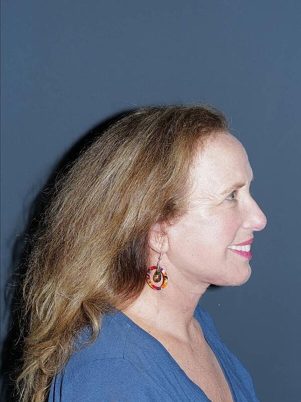 Facelift Neck Lift Before & After