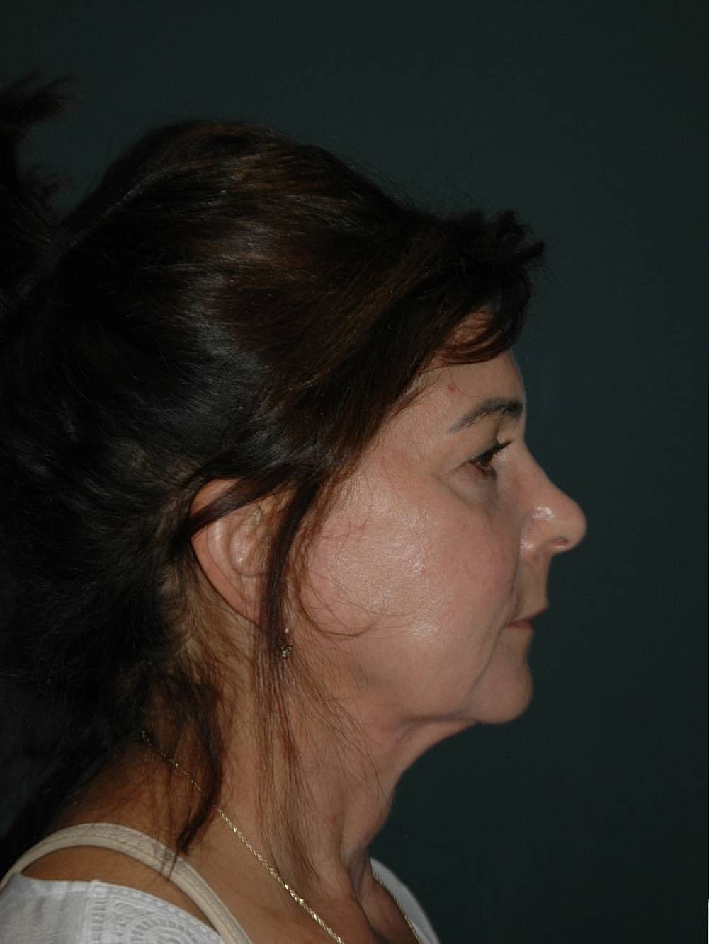 Facelift Neck Lift Before & After