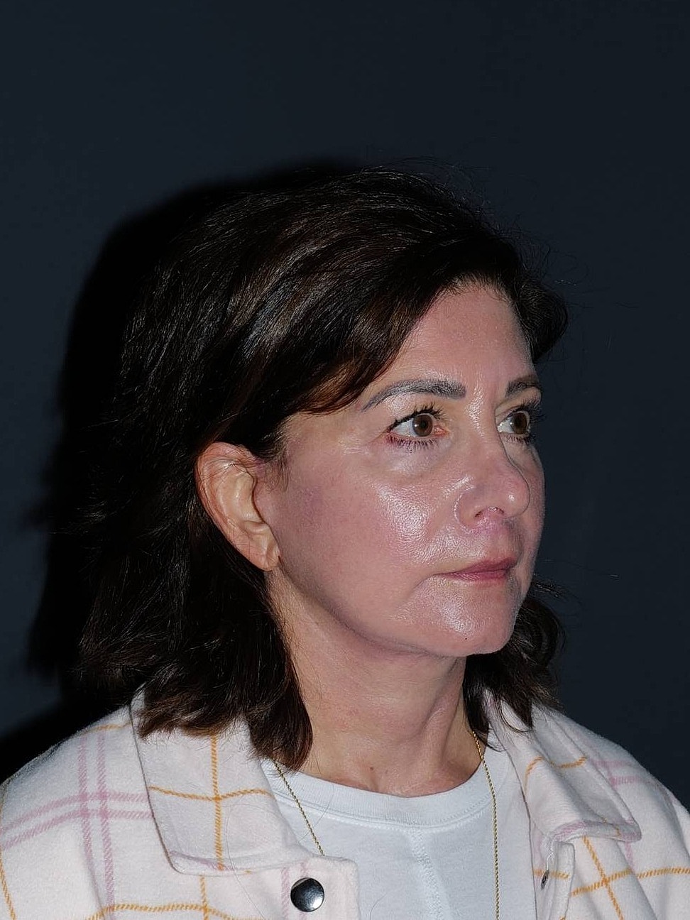 Facelift Neck Lift Before & After