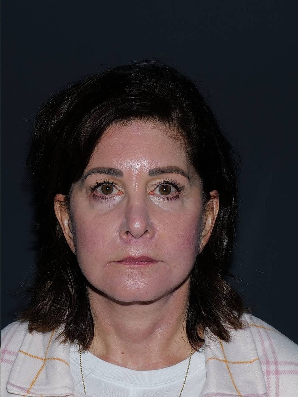 Facelift Neck Lift Before & After