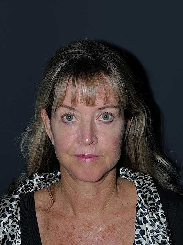 Facelift Neck Lift Before & After