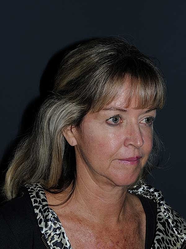 Facelift Neck Lift Before & After