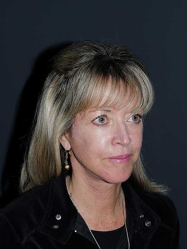 Facelift Neck Lift Before & After
