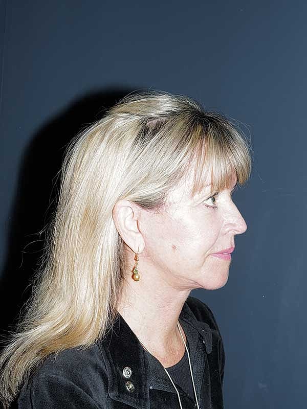 Facelift Neck Lift Before & After