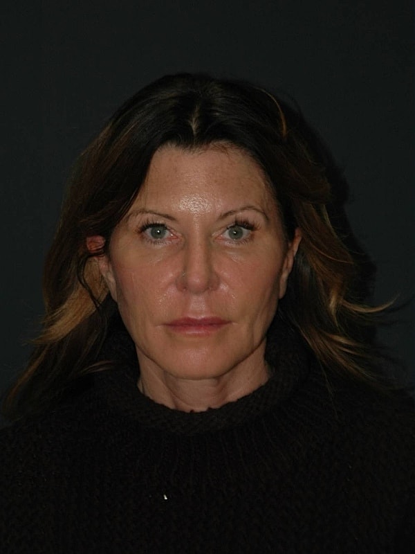 Facelift Neck Lift Before & After