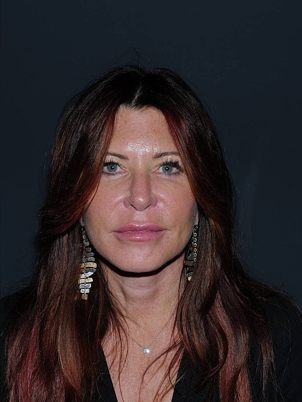 Facelift Neck Lift Before & After