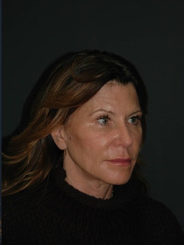 Facelift Neck Lift Before & After