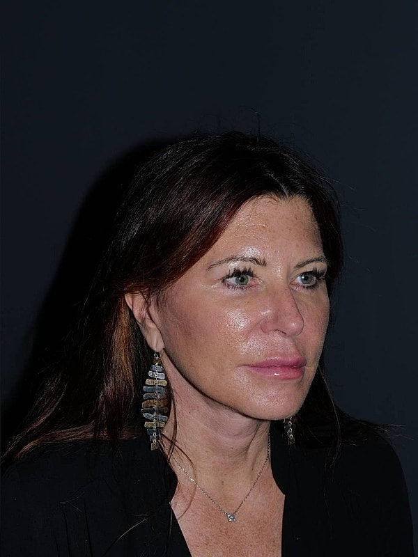 Facelift Neck Lift Before & After