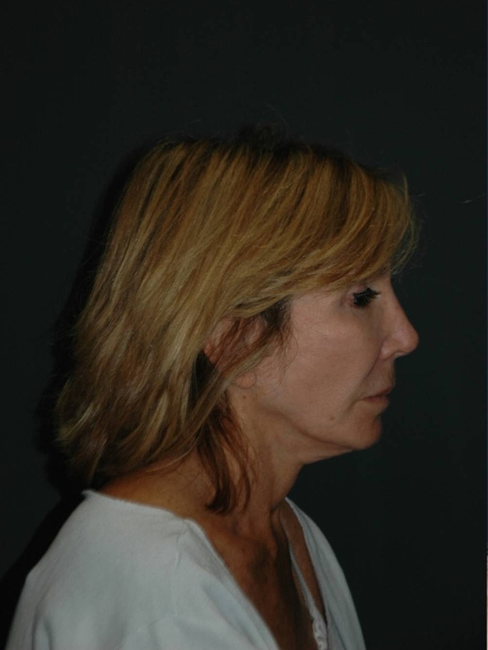 Facelift Neck Lift Before & After