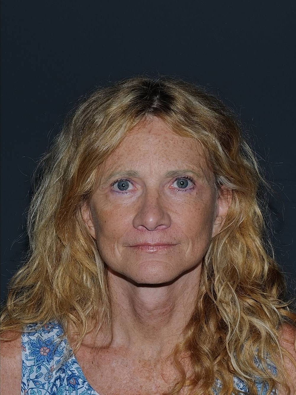 Facelift Neck Lift Before & After