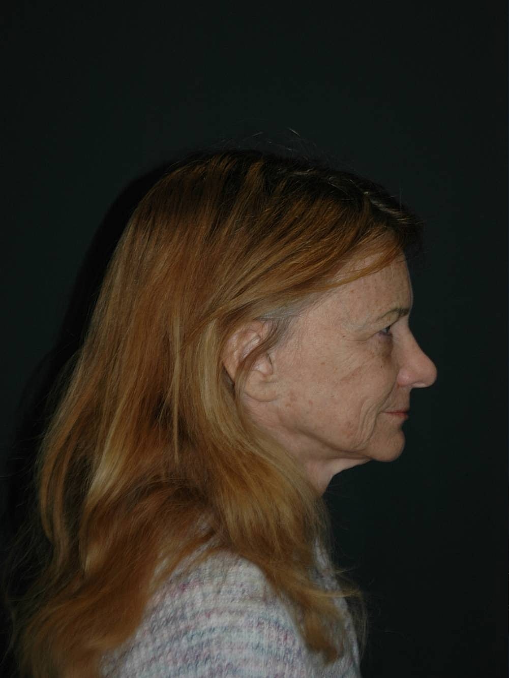 Facelift Neck Lift Before & After