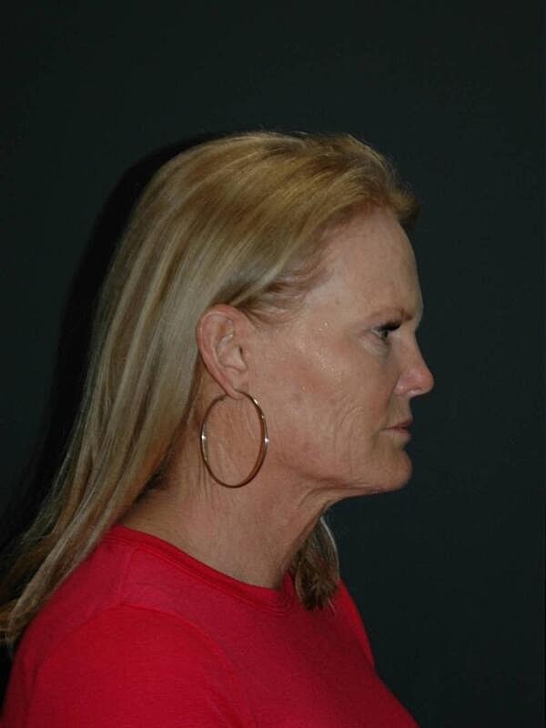Facelift Neck Lift Before & After