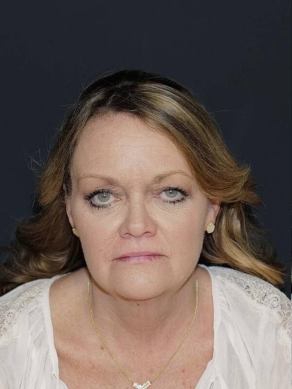 Facelift Neck Lift Before & After